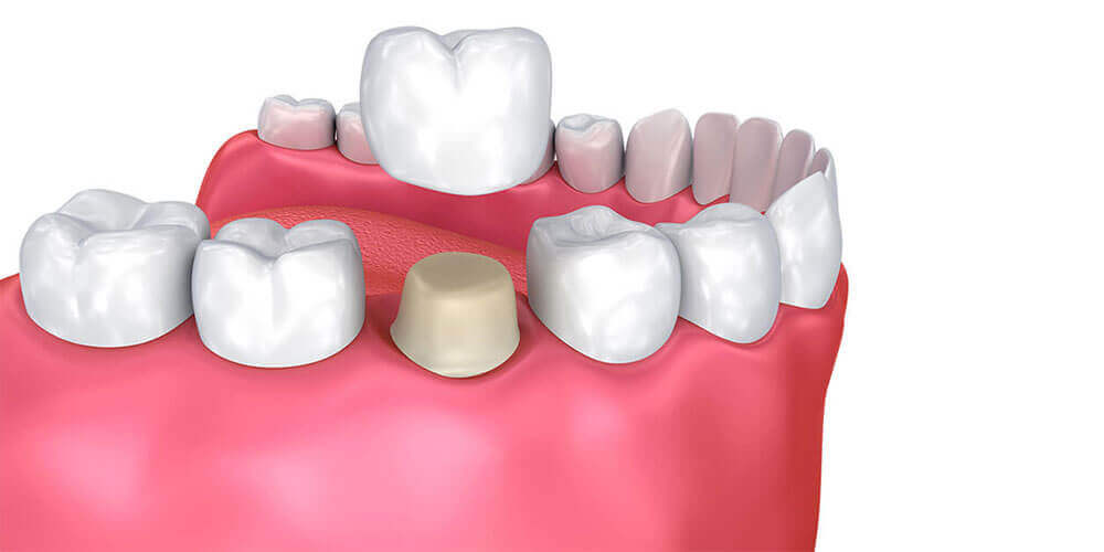 Dental Crowns London