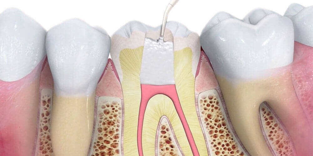 Root Canal Treatment London