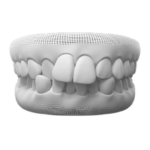 Crowded Teeth
