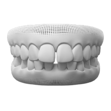 Gaps Between Teeth