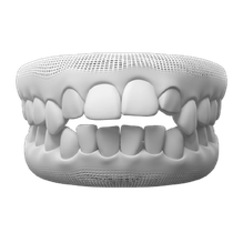 Open Bite