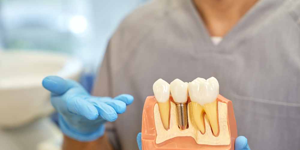 How to Maintain Your Dental Implants: Tips for Long-Lasting Results