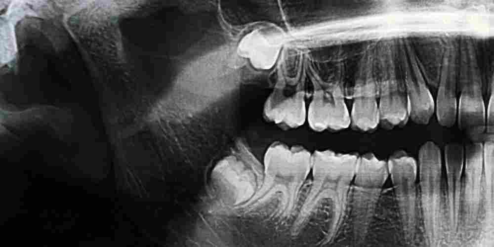 What to Expect Before, During, and After Wisdom Tooth Extraction What to Expect Before, During, and After Wisdom Tooth Extraction