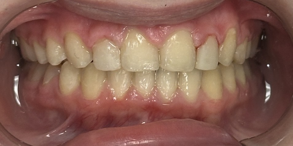 Braces with composite build up After