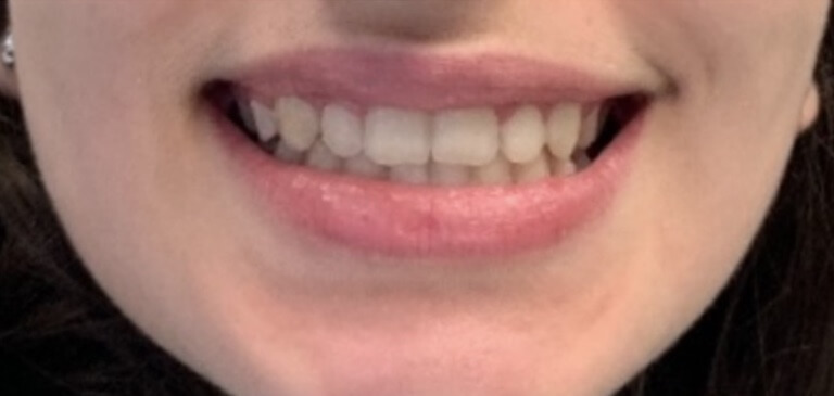 Braces After