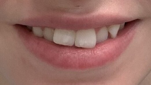 Dental Braces Before