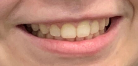 Braces After