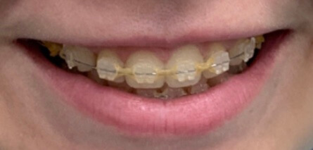 Braces Before