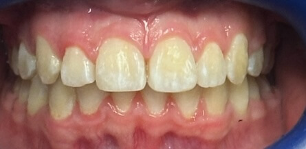 Dental Braces After