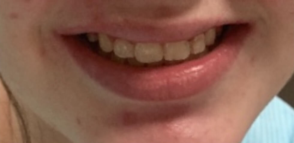 Braces After