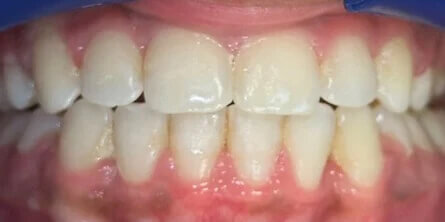 Dental Braces After