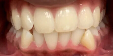 Dental Braces Before