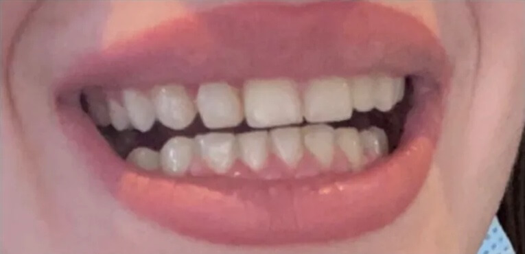 Braces And Composite Build Up After