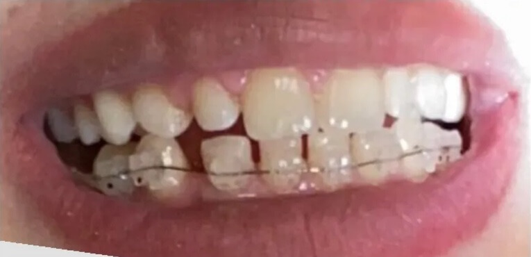 Braces And Composite Build Up Before