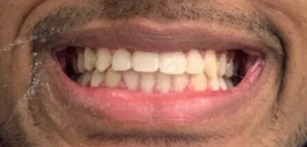 Braces After