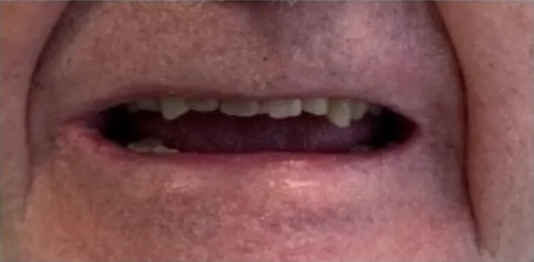 Dental Crowns Before