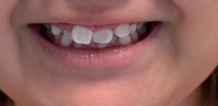 Child Braces Before