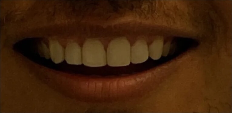 Composite Veneers After