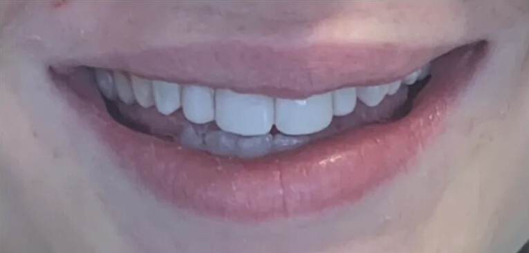 Composite Veneers After