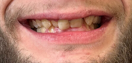 Bridge And Veneers Before