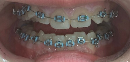 Braces Before