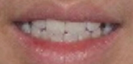 Braces Before