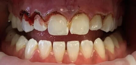 Laser Gum Treatment After