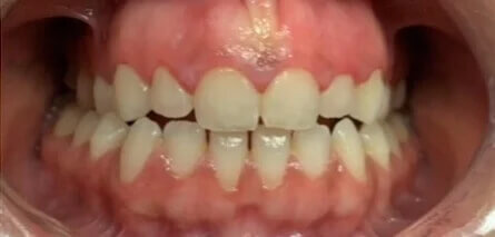 Laser Gum Treatment Before