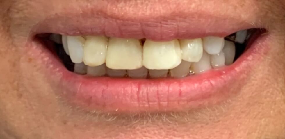 Composite Veneers After