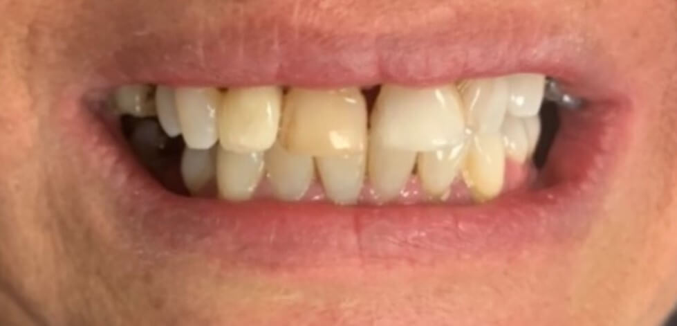 Composite Veneers Before