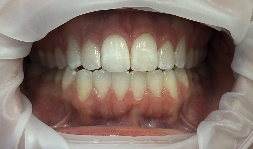 Invisalign After