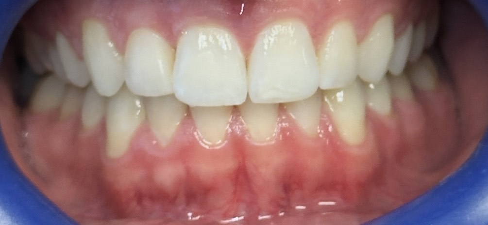 Invisalign After