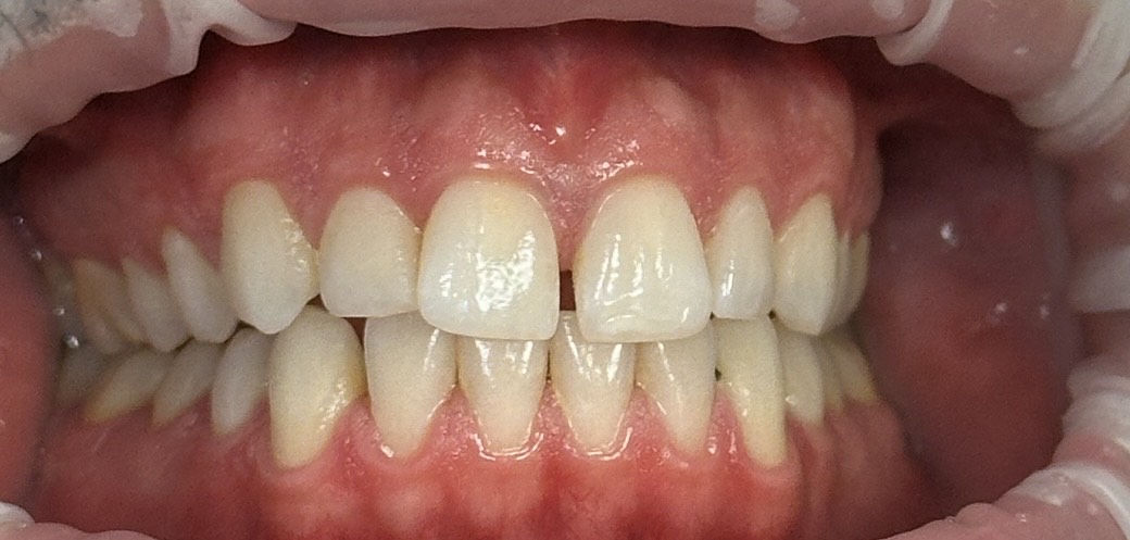 Invisalign Before