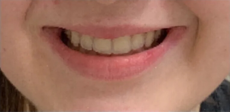 Invisalign After