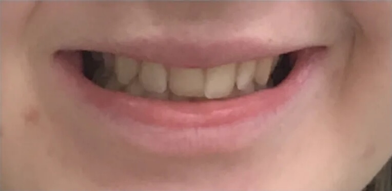 Invisalign Before