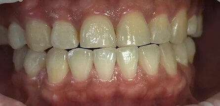 Invisalign After