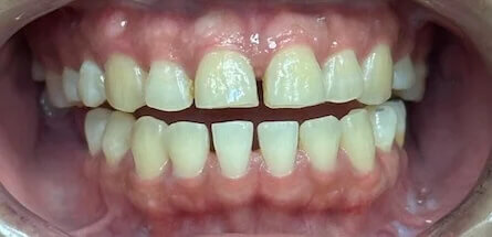 Invisalign Before