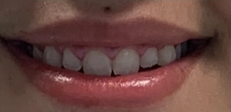 Laser Gum Treatment After