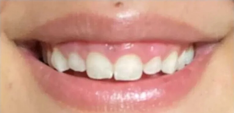 Laser Gum Treatment Before