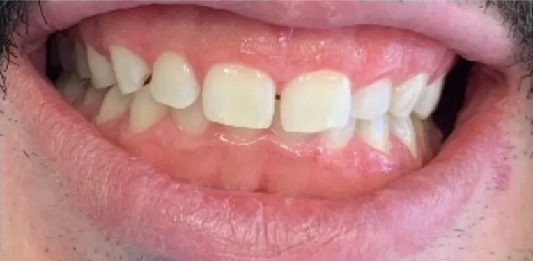 Laser Gum Treatment Before