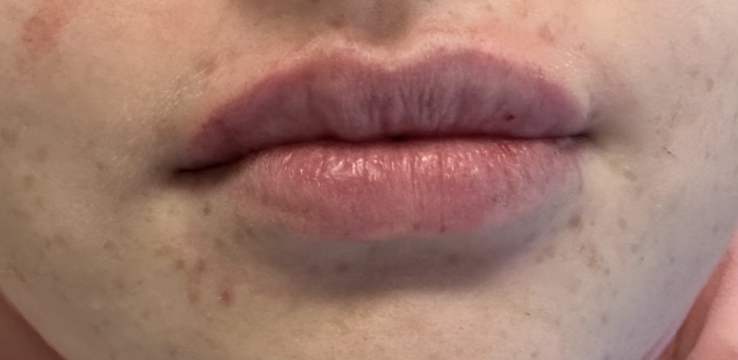 Lip Filler After