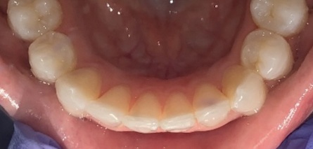 Invisalign After