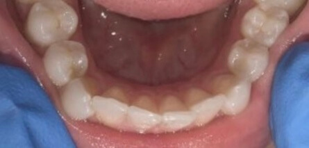 Invisalign Before