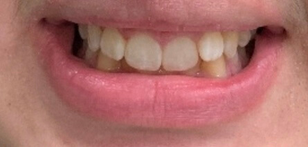 Braces Before