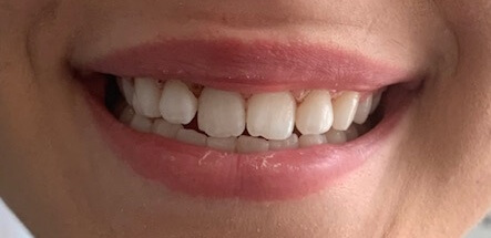 Laser Gingivectomy After