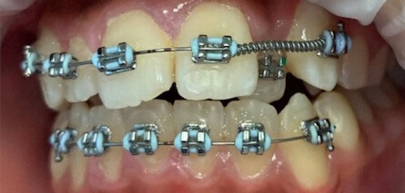 Braces Before